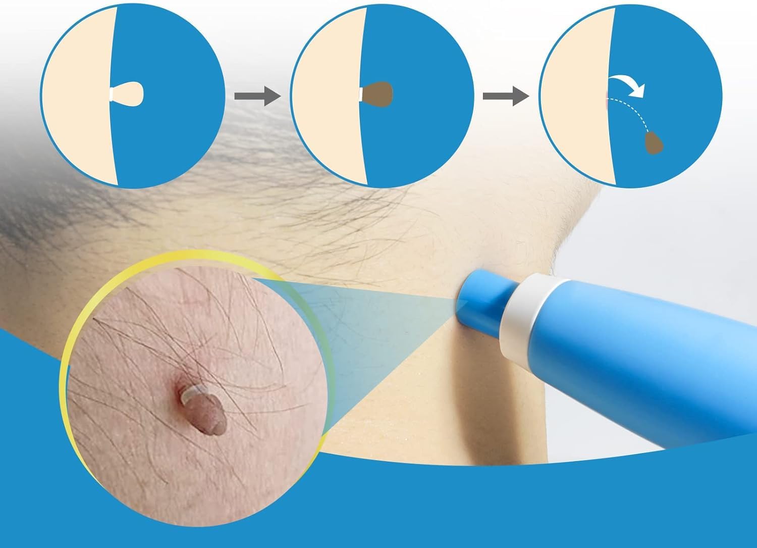 Painless Auto Skin Tag & Mole  - Health Wellness 评论和价格
