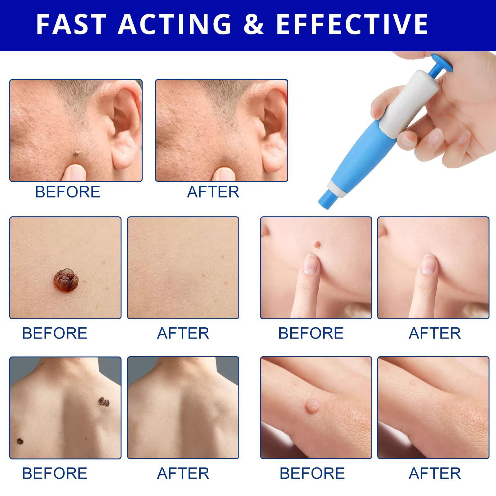Painless Auto Skin Tag & Mole  - Health Wellness 评论和价格
